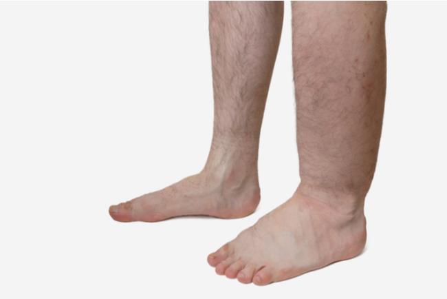 נפיחות ברגליים בשל אי ספיקה ורידית 